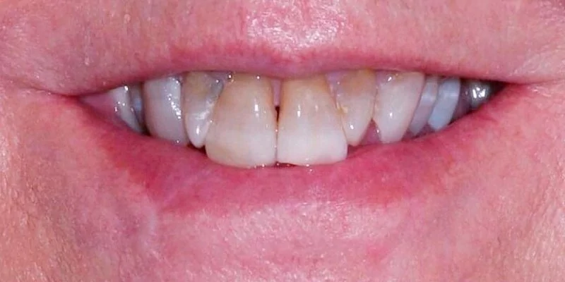 До - Керамические коронки и виниры Emax